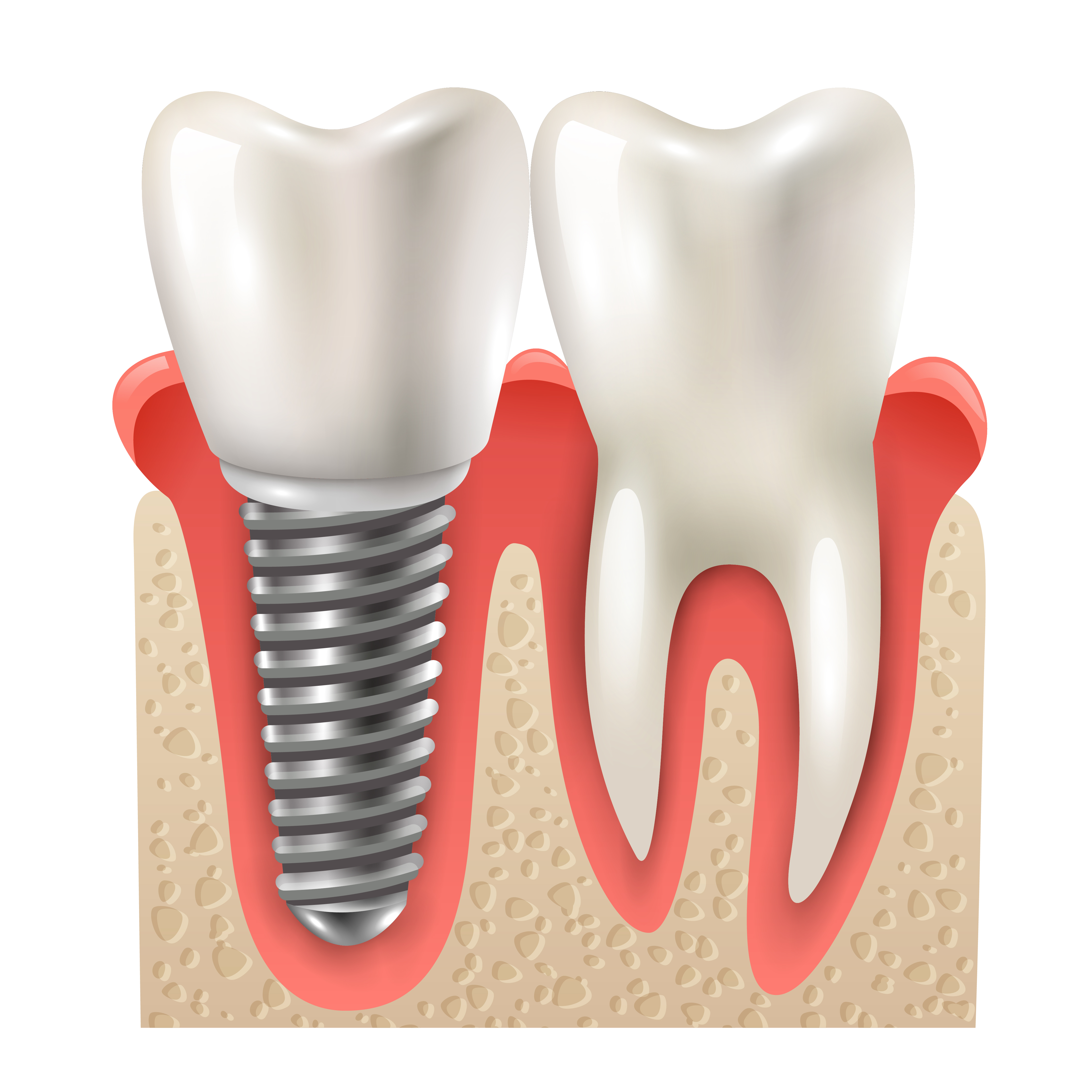 Dental Implant Service